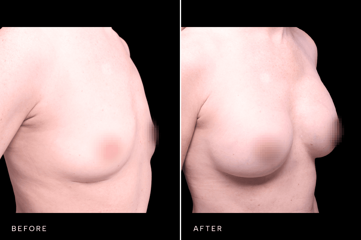 Omni Breast Gallery - BAM 9757 - E Angle