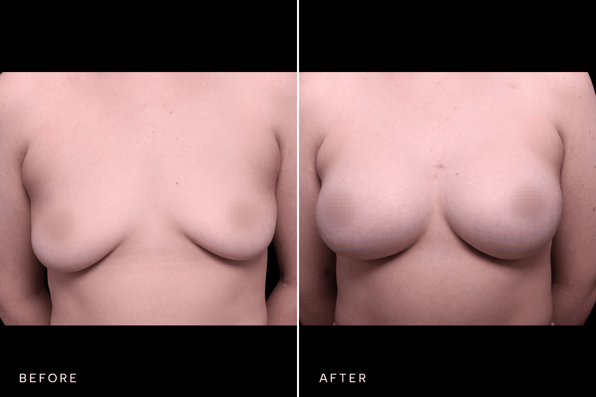 Omni Breast Gallery - BAM 6167 - A Front
