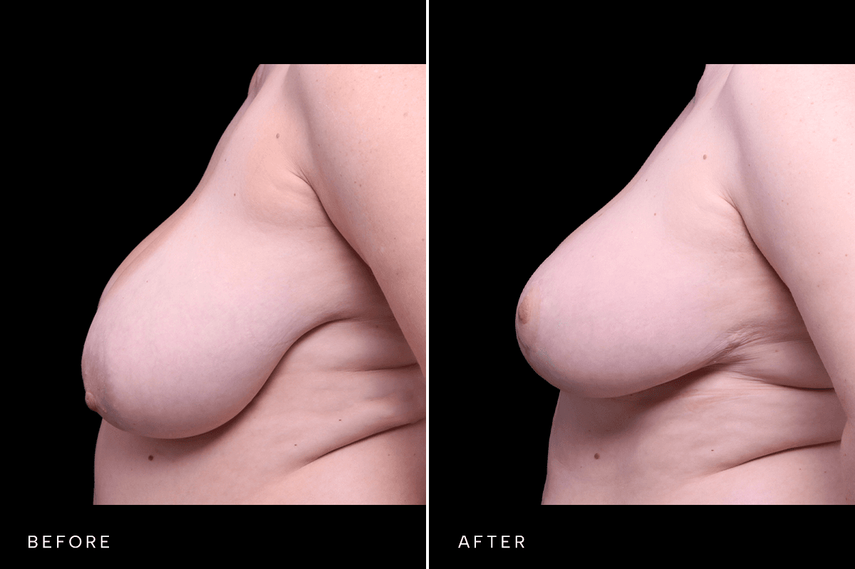 Omni Breast Gallery - MASTO 5567 - D Side