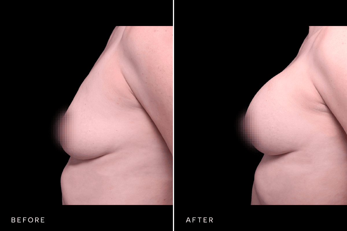 Omni Breast Gallery - BAM 6305 - E Side