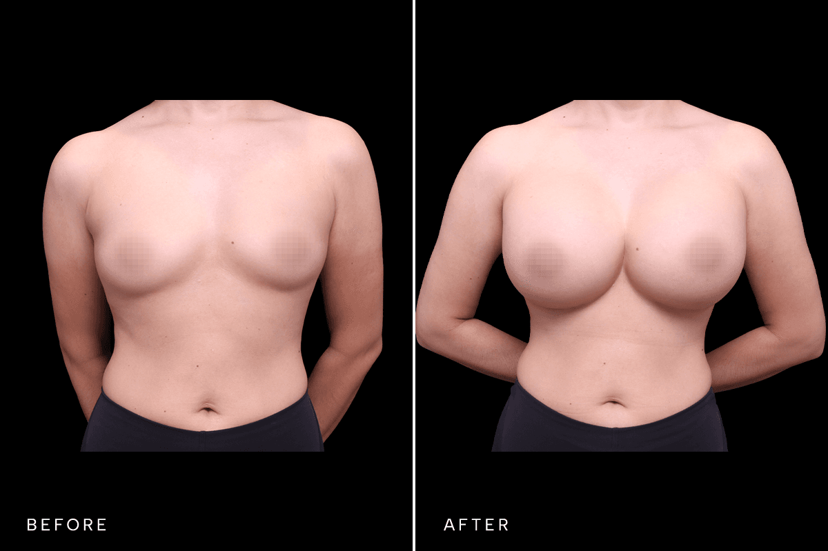 Omni Breast Gallery - BAM 4748 - A Front