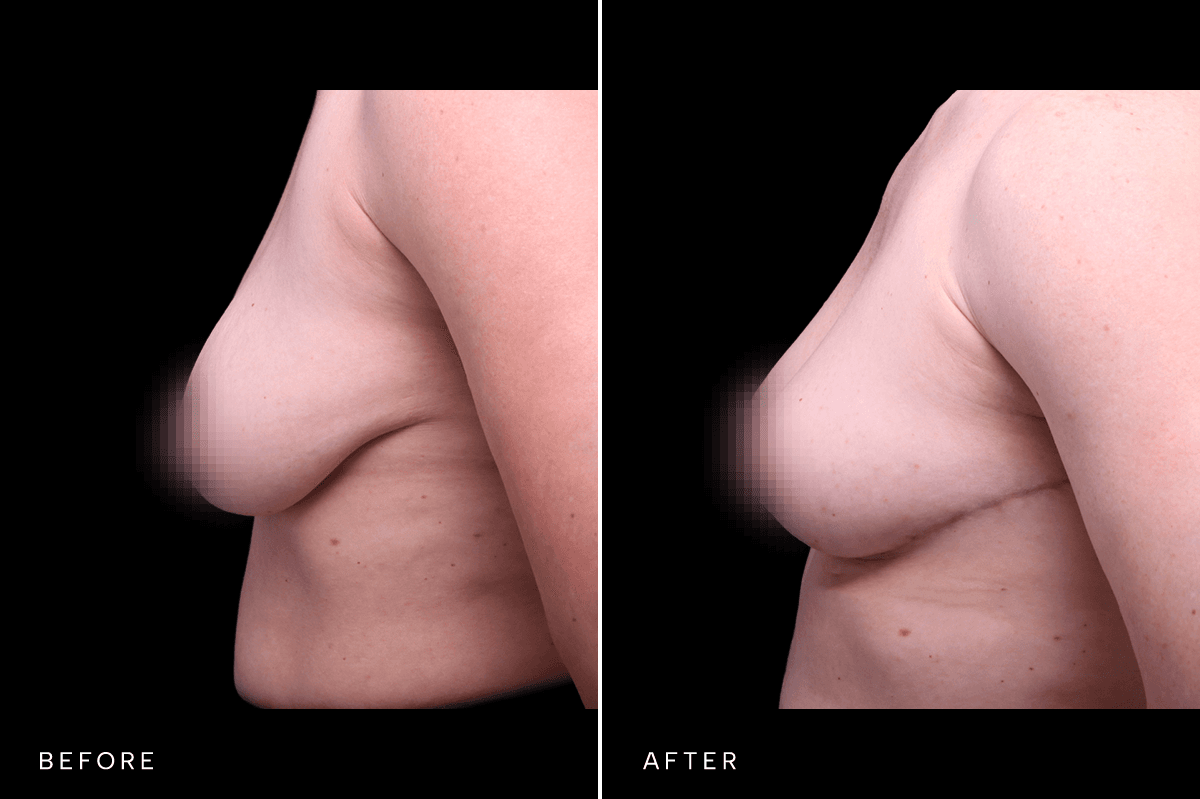 Omni Breast Gallery - MASTO AFG 6548 - C Side