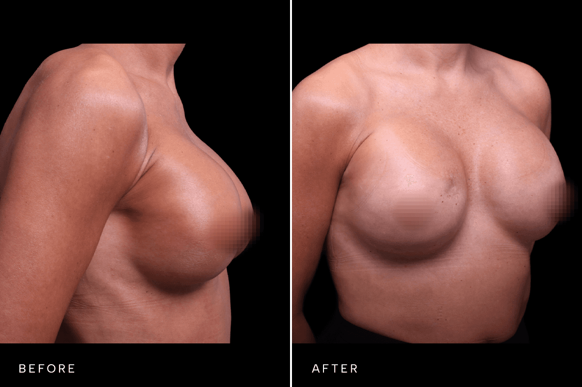 Omni Breast Gallery - BAM 9237 - C Angle