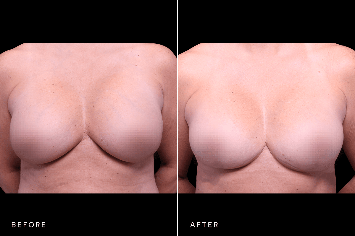 Omni Breast Gallery - MASTO BAM 5933 - A Front