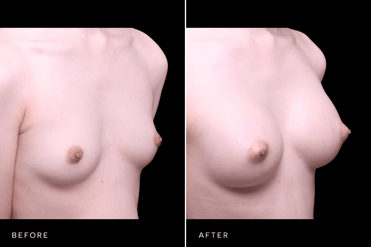 Omni Breast Gallery - BAM GC 6505 - C Angle