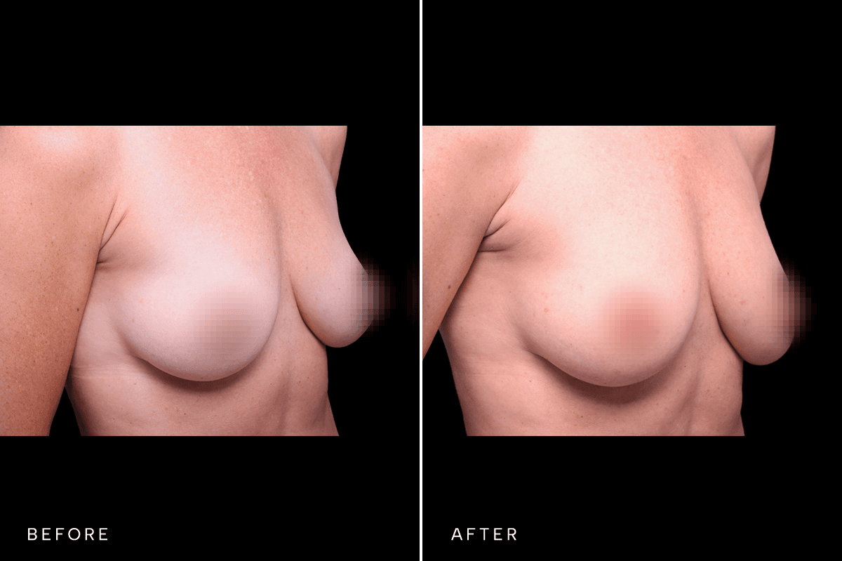 Omni Breast Gallery - FGI 17284 - D Angle