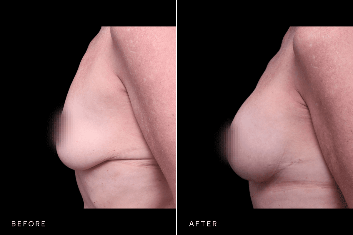 Omni Breast Gallery - MASTO BAM 5475 - C Side