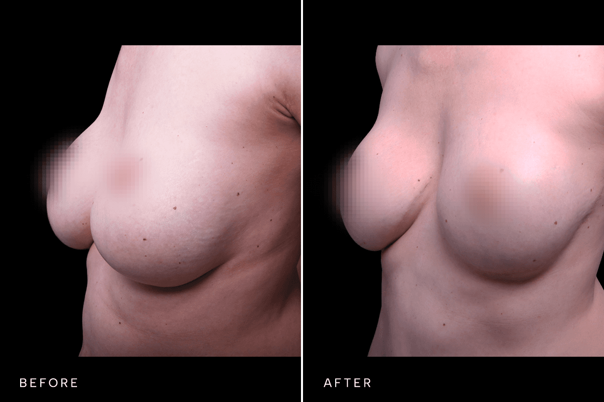 Omni Breast Gallery - MASTO 5977 - D Angle