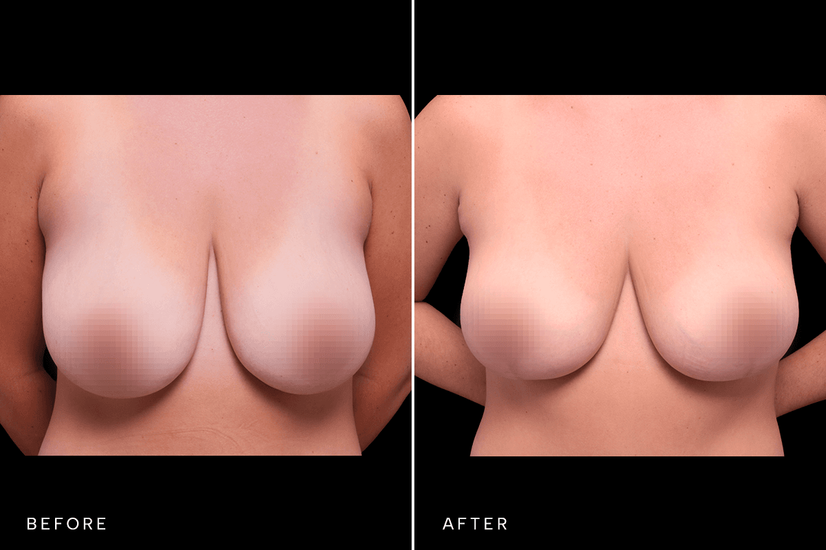 Omni Breast Gallery - Masto 4783 - A Front