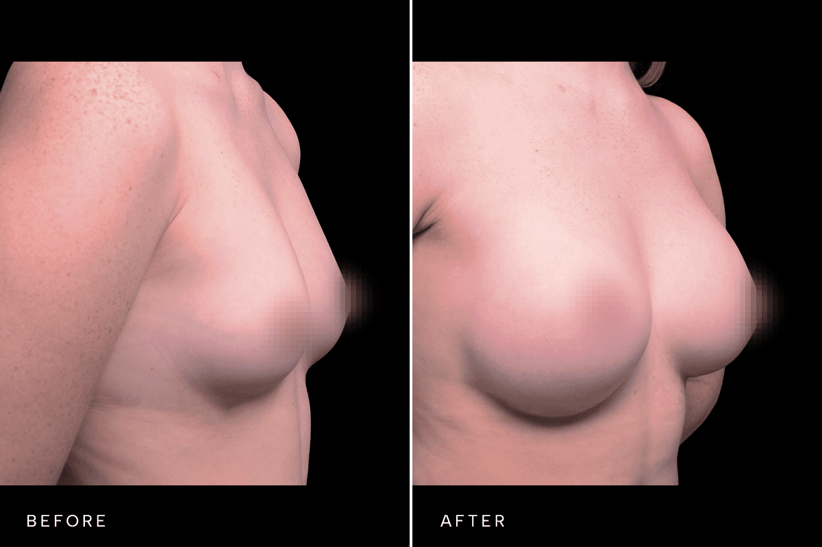 Omni Breast Gallery - BAM 5466 - C Angle