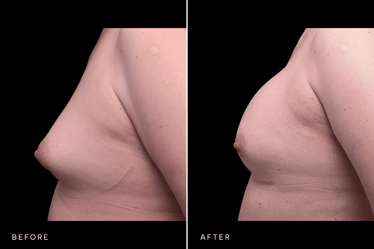 Omni Breast Gallery - BAM GC 6239 - B Side