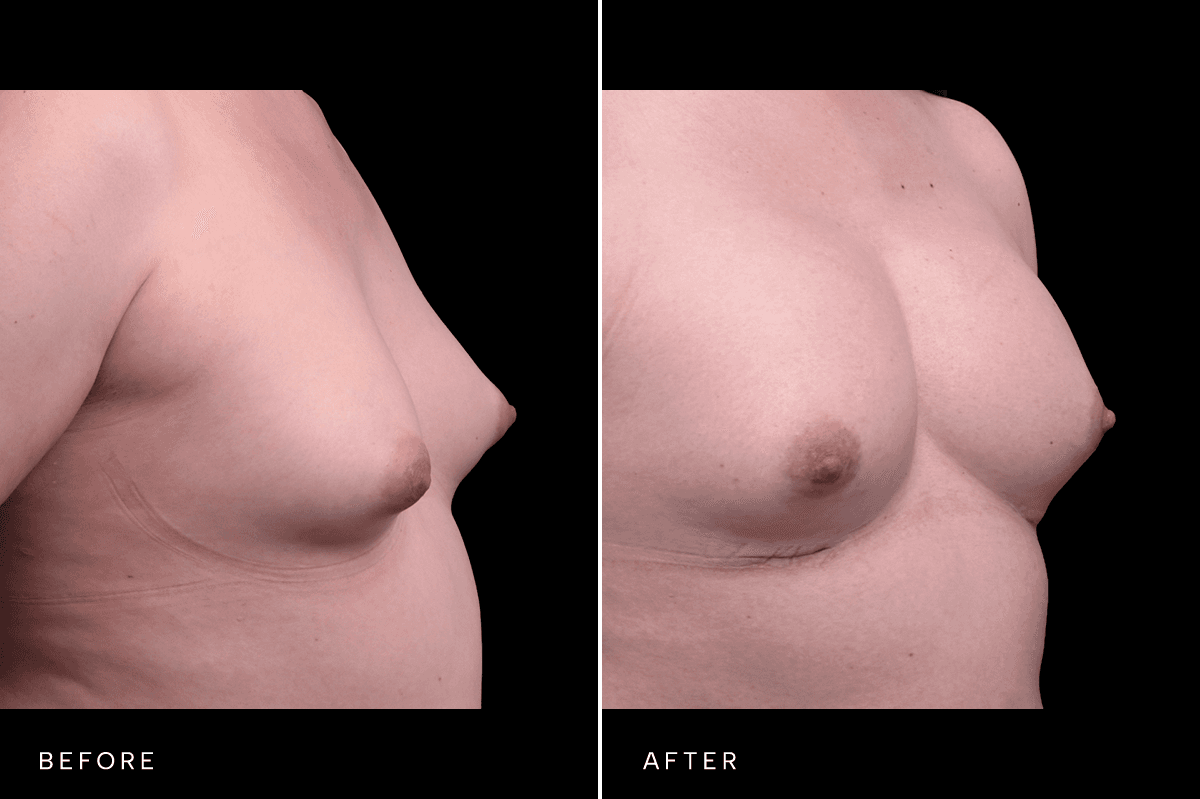 Omni Breast Gallery - BAM GC 6239 - C Angle
