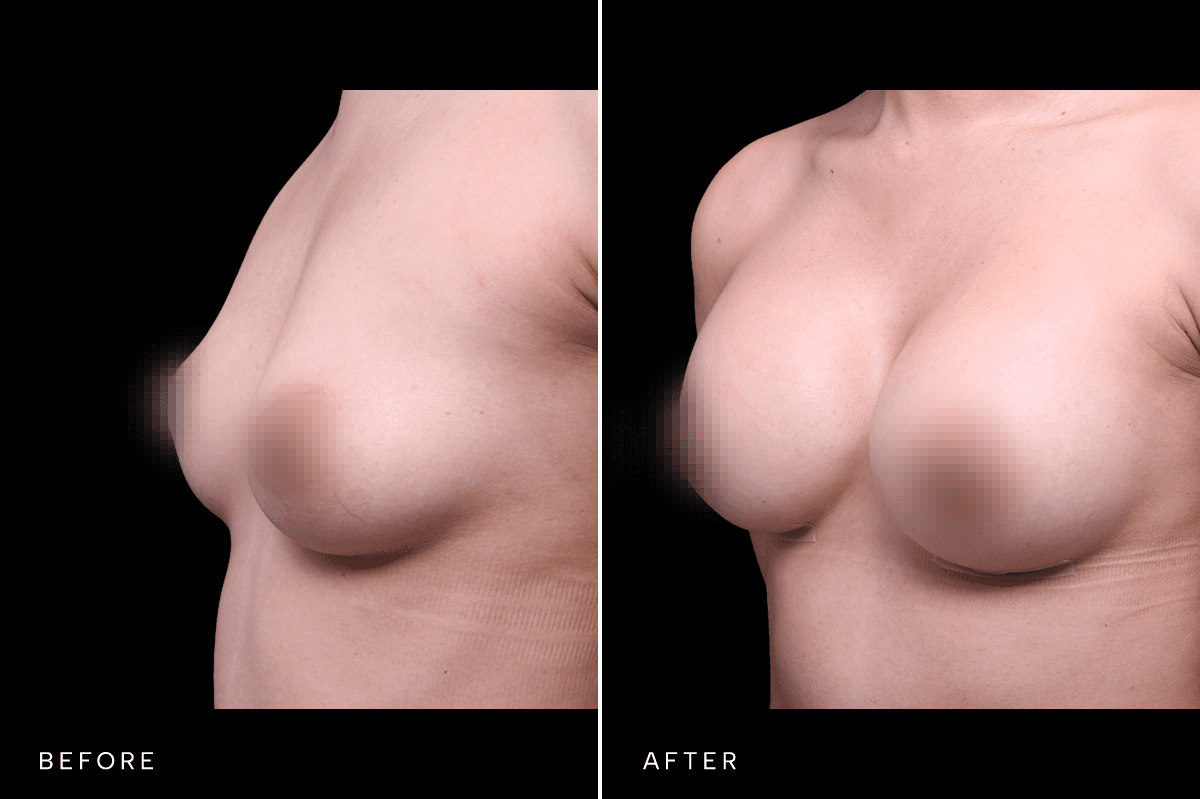 Omni Breast Gallery - BAM 6037 - C Angle