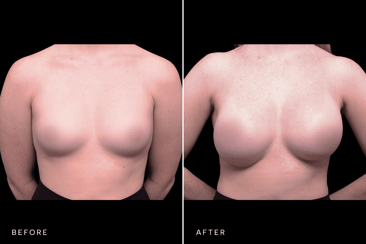 Omni Breast Gallery - BAM 5466 - A Front
