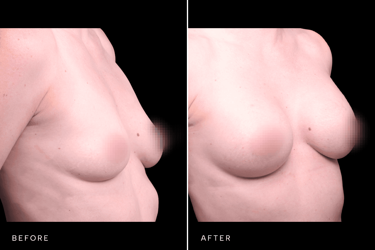 Omni Breast Gallery - BAM 6305 - C Angle
