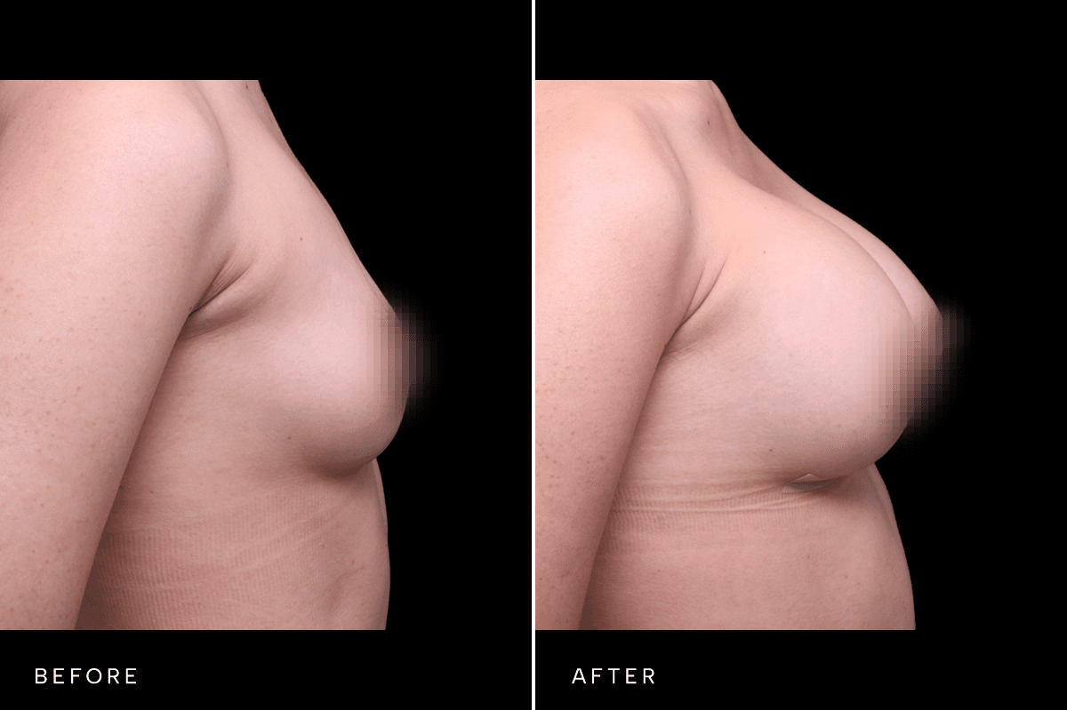 Omni Breast Gallery - BAM 6037 - B Side