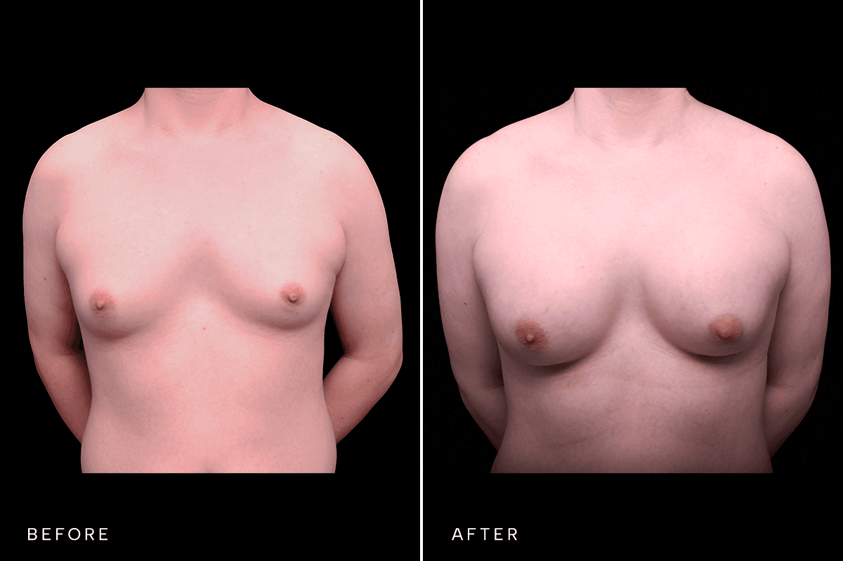 Omni Breast Gallery - BAM 4556 GC - A Front