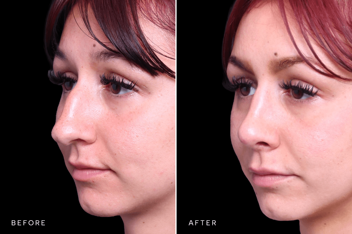 Omni Rhinoplasty Before and After — RHINO 6350 - C Angle