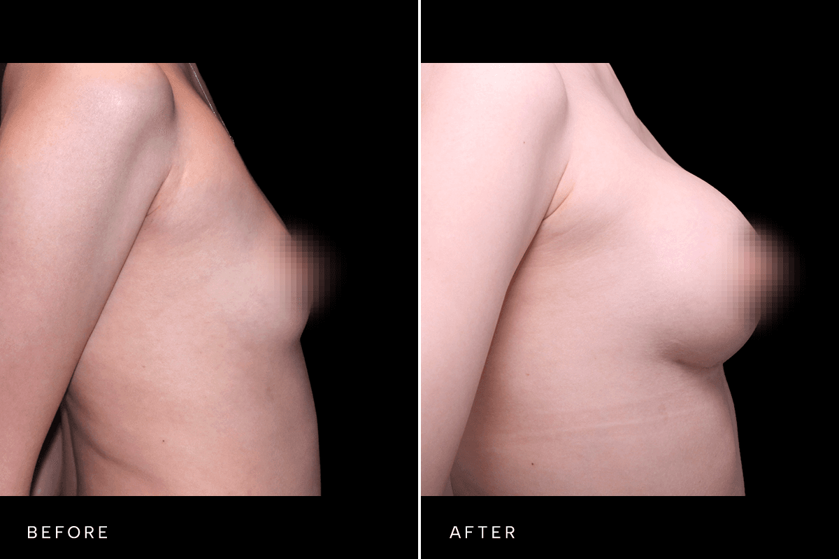 Omni Breast Gallery - BAM 6629 - E Side