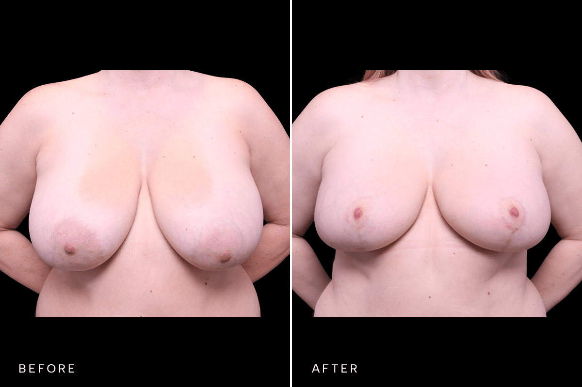 Omni Breast Gallery - MASTO 5567 - A Front
