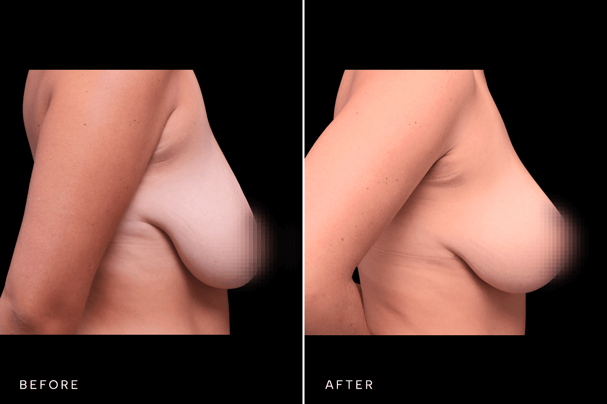 Omni Breast Gallery - Masto 4783 - D Angle
