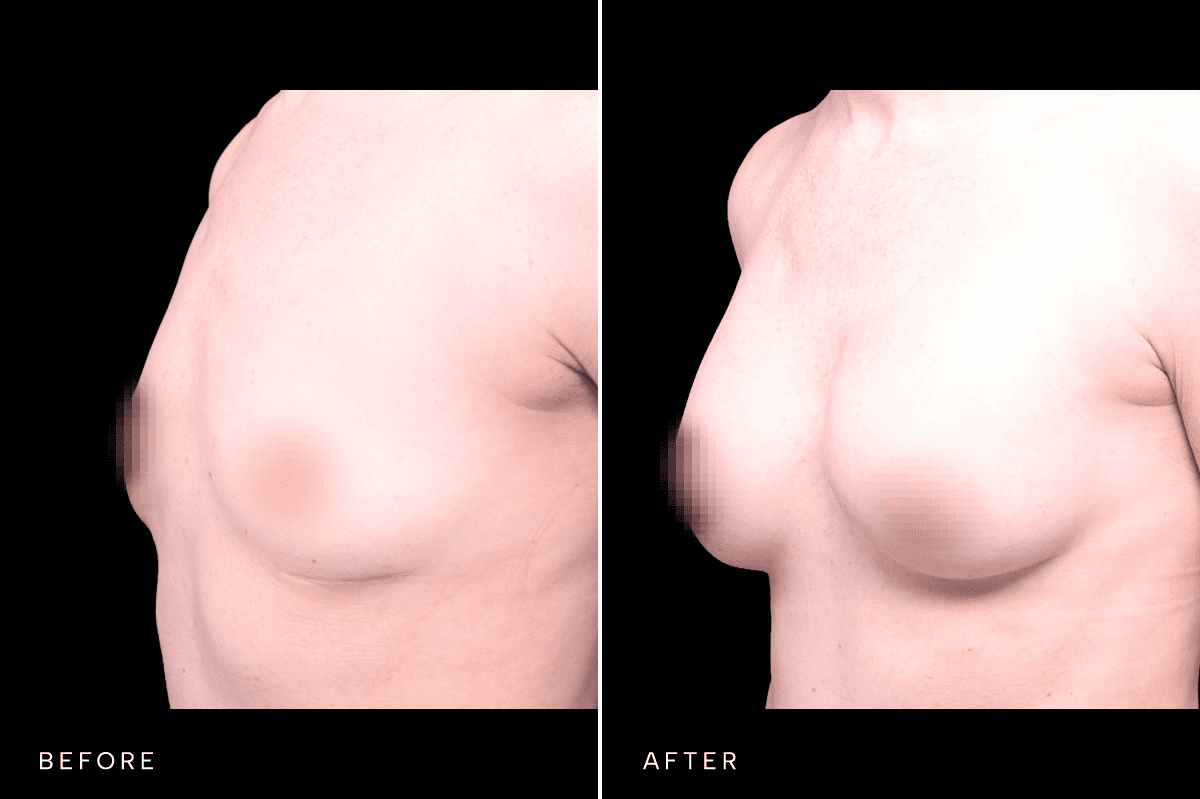 Omni Breast Gallery - BAM 9757 - D Angle