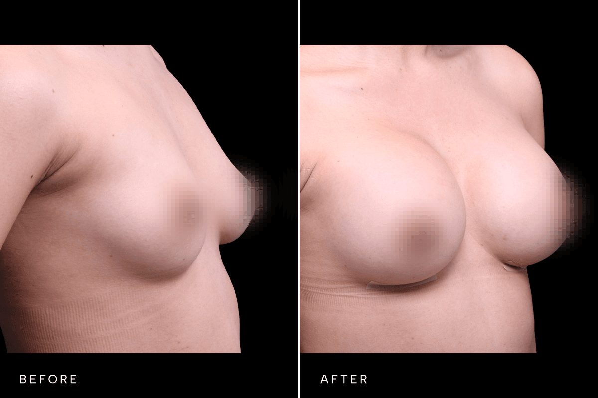 Omni Breast Gallery - BAM 6037 - E Angle