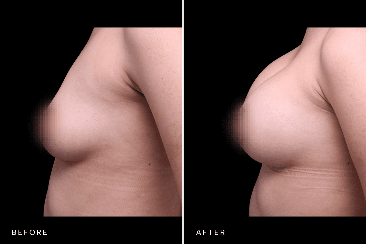 Omni Breast Gallery - BAM 6037 - D Side