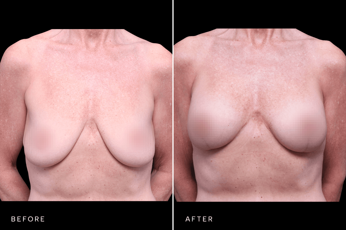 Omni Breast Gallery - MASTO BAM 5475 - A Front