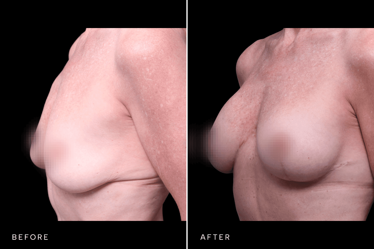 Omni Breast Gallery - MASTO BAM 5475 - B Angle