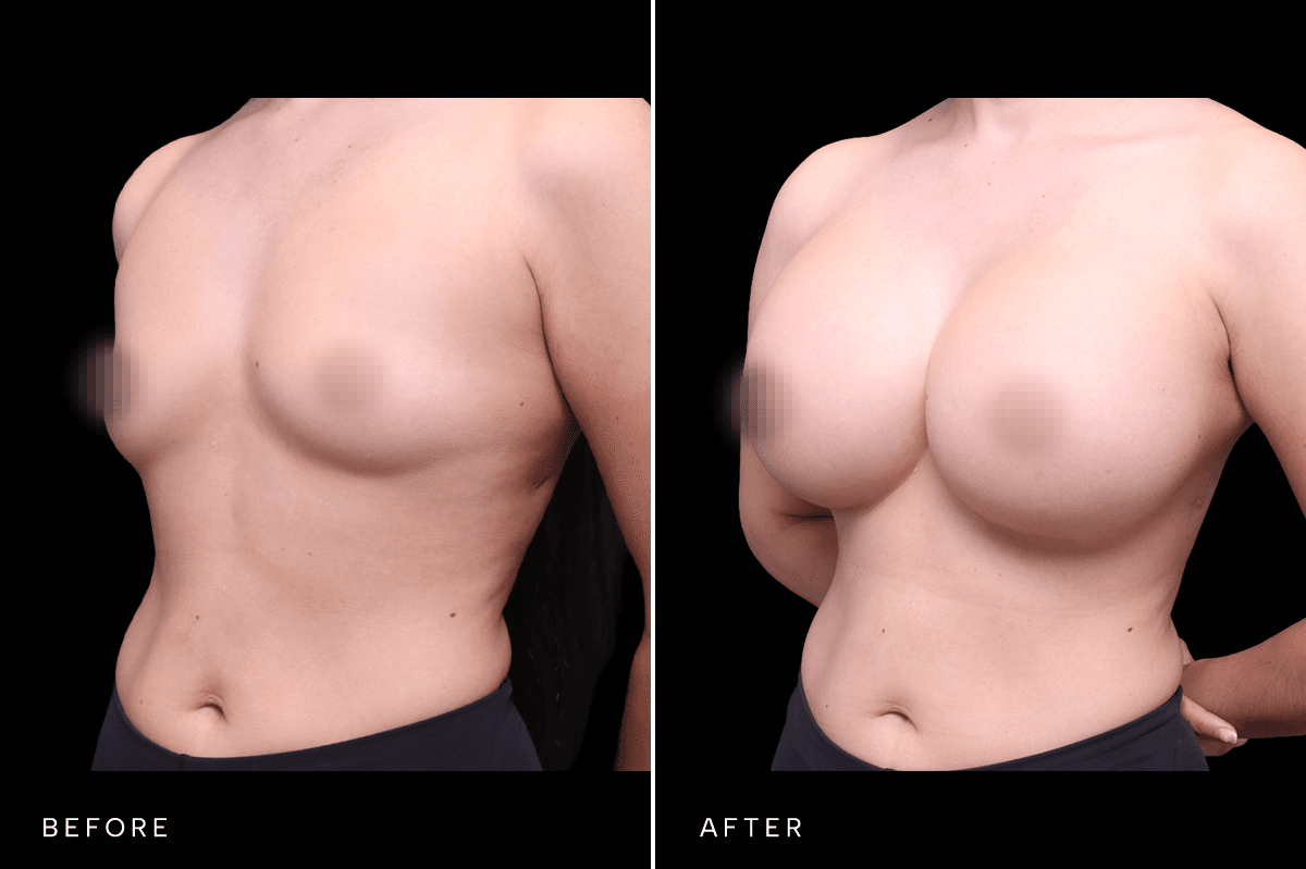 Omni Breast Gallery - BAM 4748 - C Angle