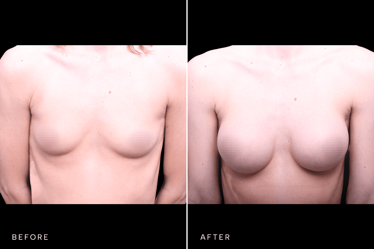 Omni Breast Gallery - BAM 6400 - A Front