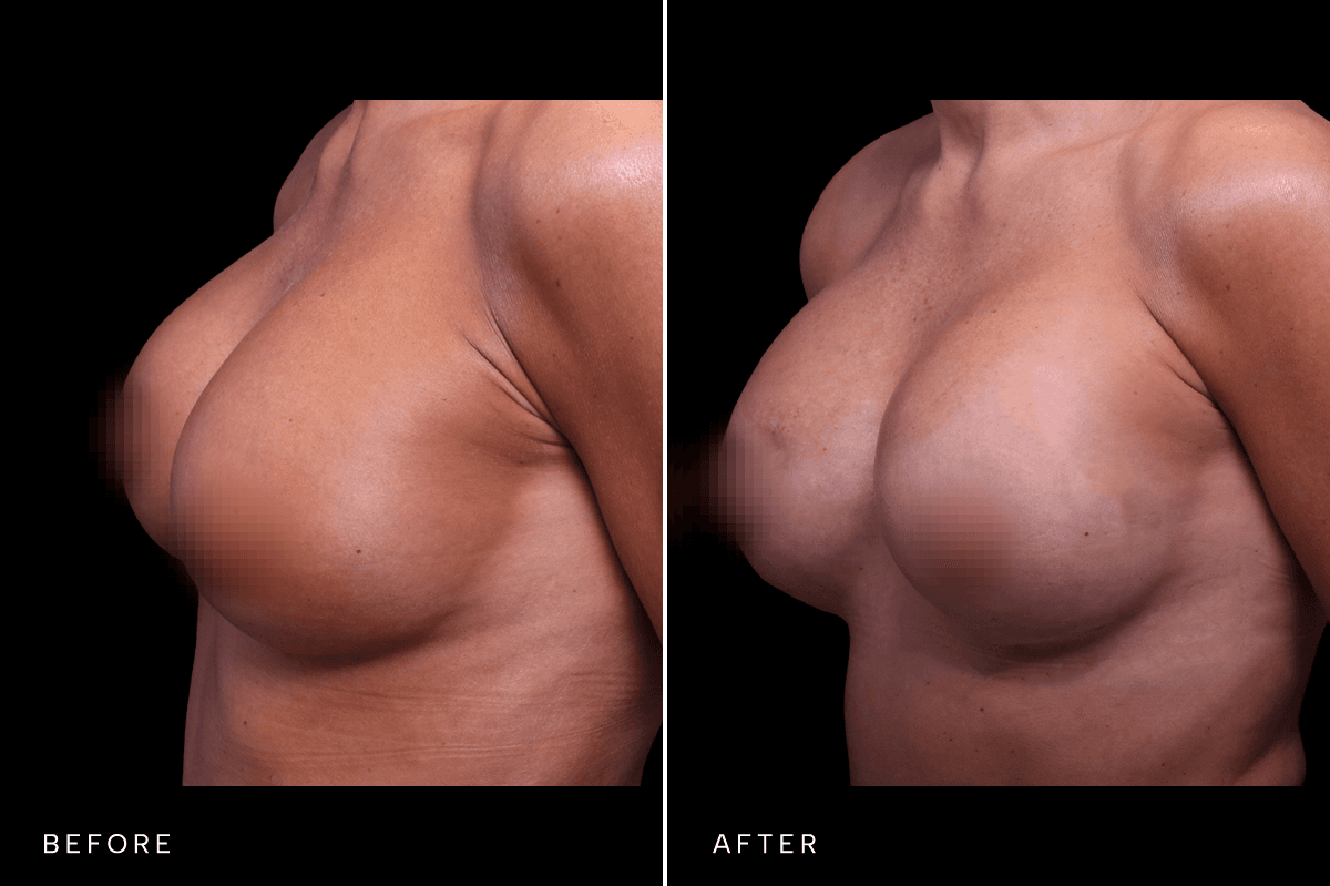 Omni Breast Gallery - BAM 9237 - E Angle