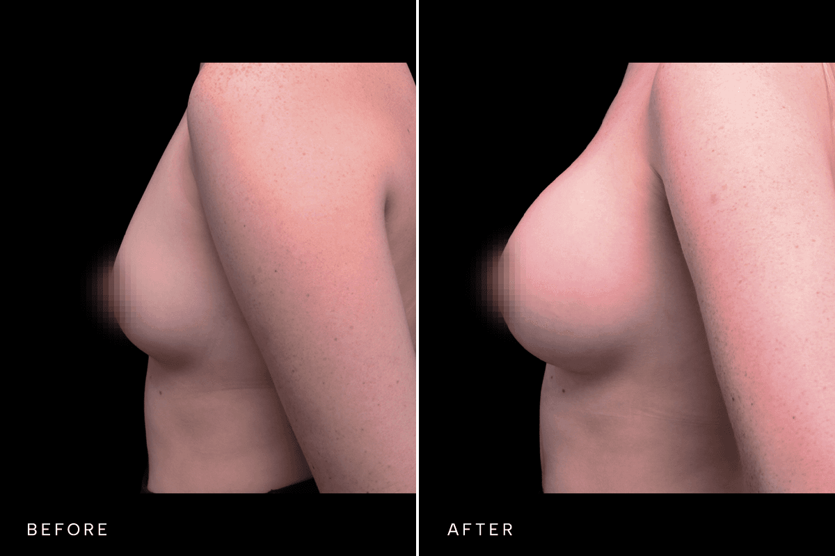 Omni Breast Gallery - BAM 5466 - D Side