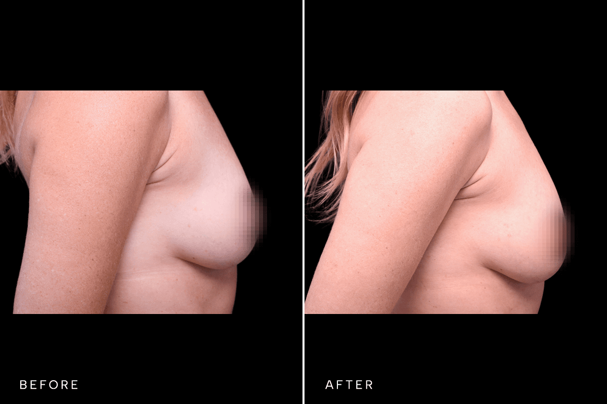Omni Breast Gallery - FGI 17284 - E Side