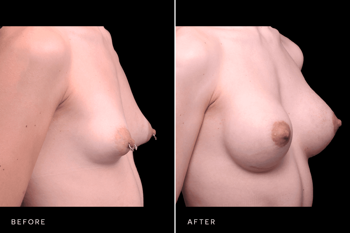 Omni Breast Gallery - BAM GC 5083 - C Angle