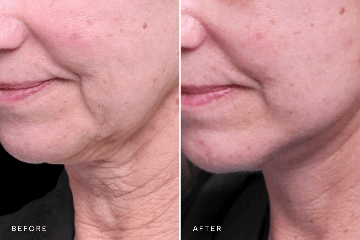 Omni Face Gallery - DP FACELIFT 5527 - D Angle