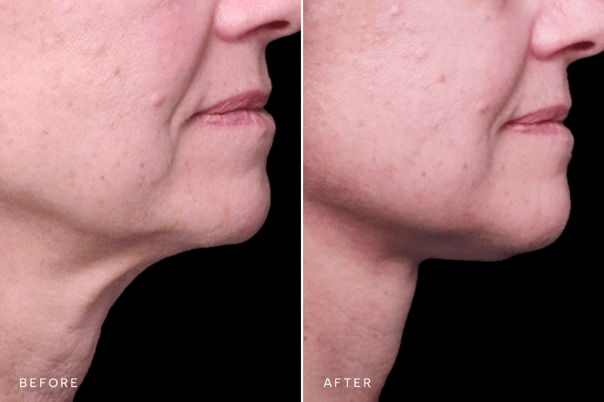 Omni Face Gallery - DP FACELIFT 5527 - B Side