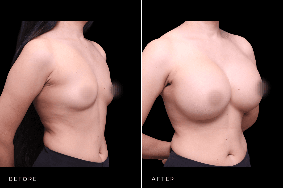 Omni Breast Gallery - BAM 4748 - E Angle
