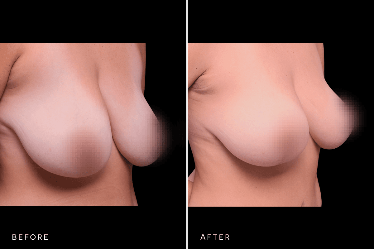 Omni Breast Gallery - Masto 4783 - E Side