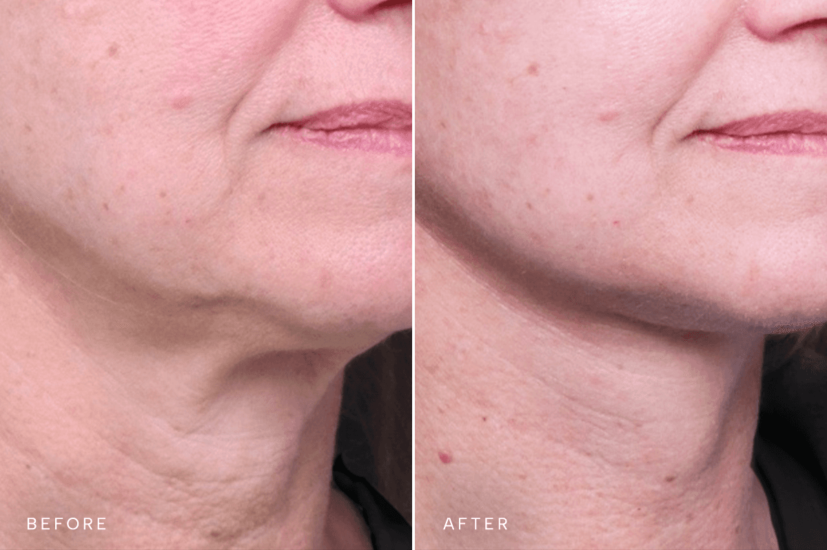 Omni Face Gallery - DP FACELIFT 5527 - C Angle