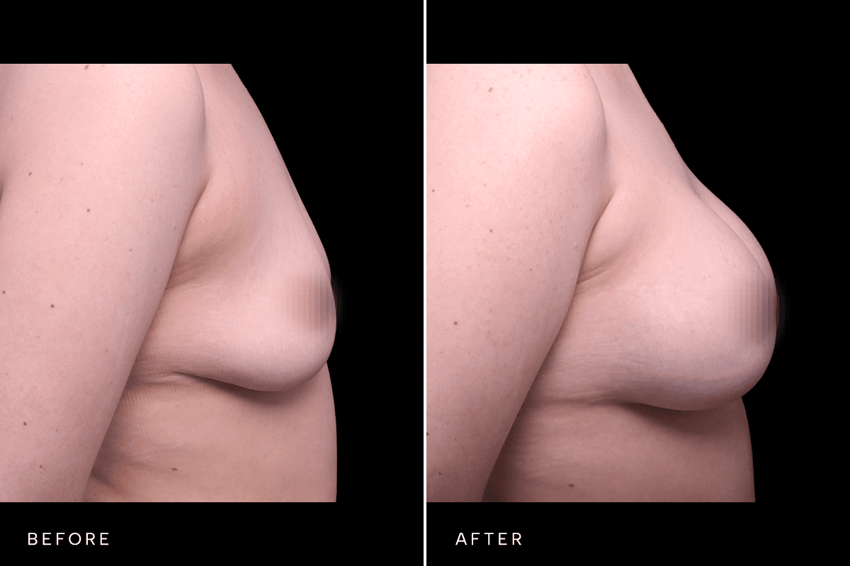 Omni Breast Gallery - BAM 6167 - B Side