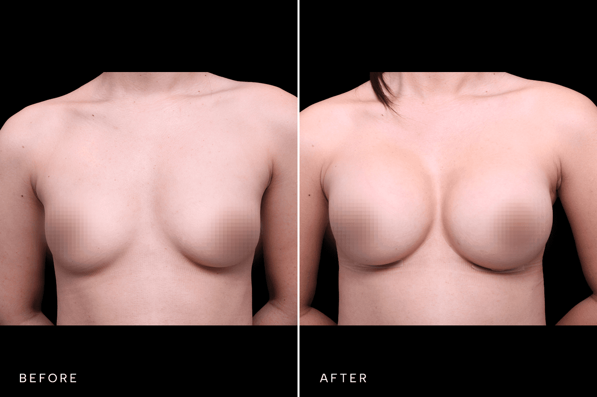 Omni Breast Gallery - BAM 6037 - A Front
