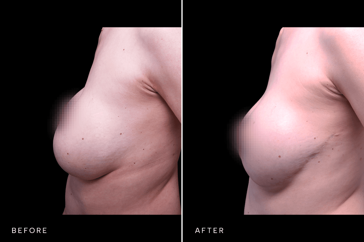 Omni Breast Gallery - MASTO 5977 - B Side