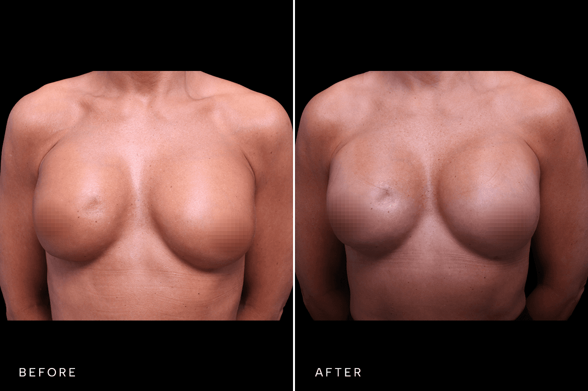 Omni Breast Gallery - BAM 9237 - A Front