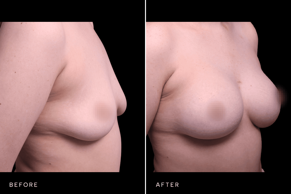 Omni Breast Gallery - BAM 6167 - E Angle