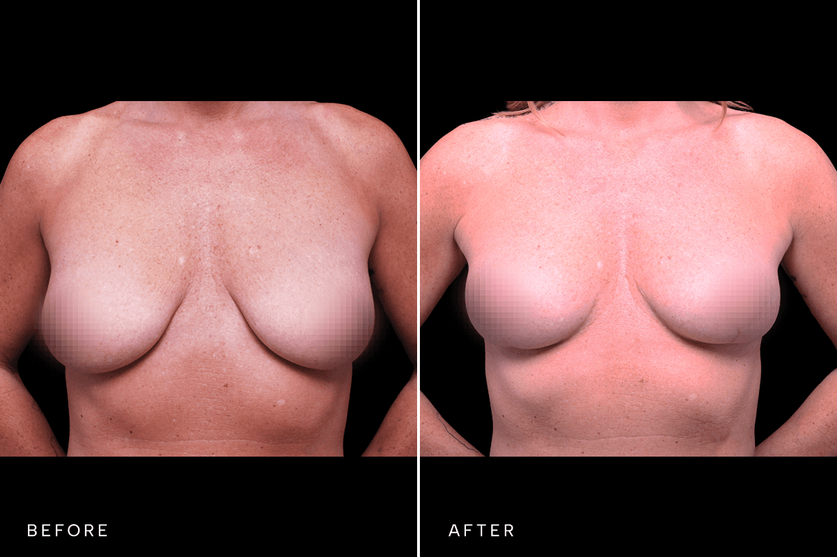 Omni Breast Gallery - MASTO FGI 6034 - A Front