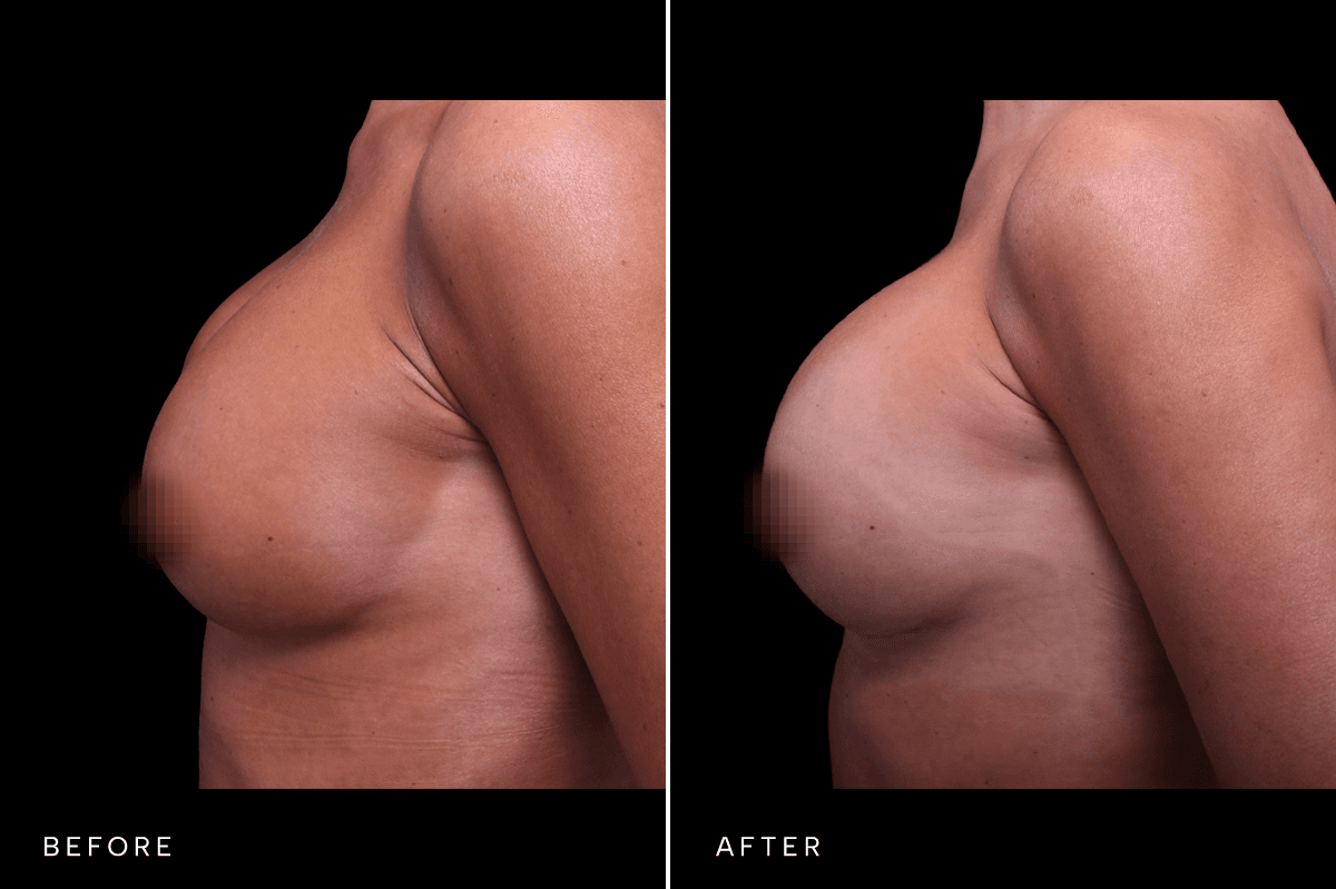Omni Breast Gallery - BAM 9237 - D Side