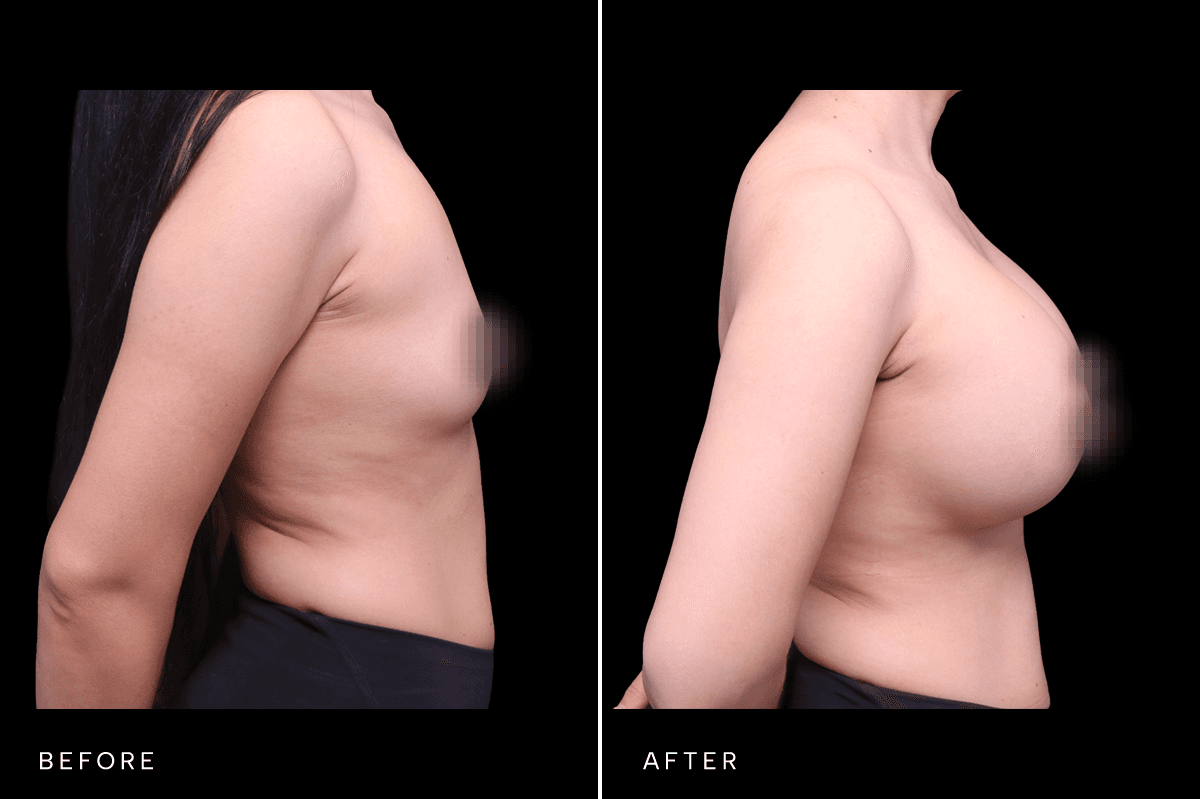 Omni Breast Gallery - BAM 4748 - D Side