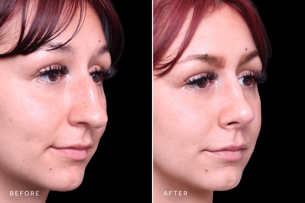 Omni Rhinoplasty Before and After — RHINO 6350 - D Angle